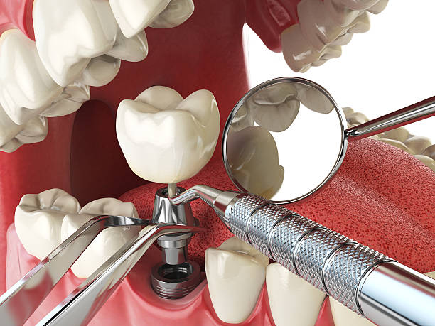 Best Emergency Tooth Extraction in Standish, MI